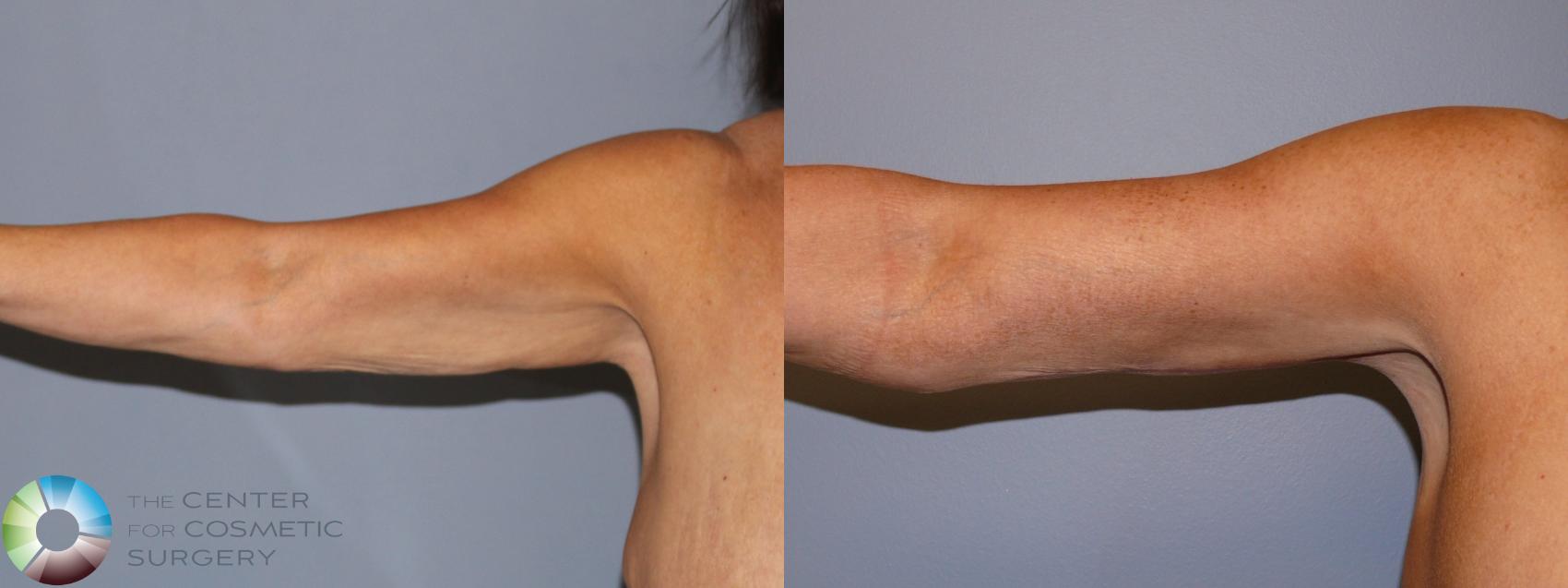 Before & After Arm Lift Case 11940 Front in Denver and Colorado Springs, CO