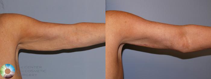 Before & After Arm Lift Case 11940 Front (left) View in Golden, CO