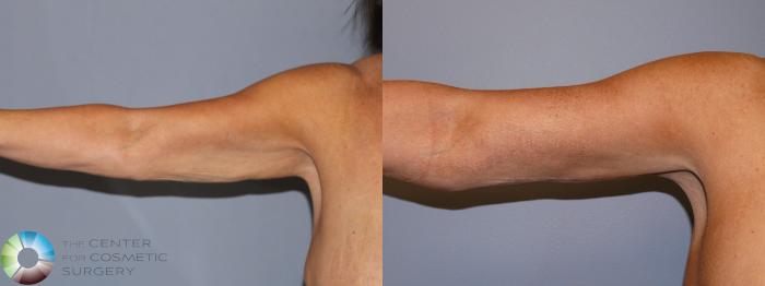 Before & After Arm Lift Case 11940 Front View in Golden, CO
