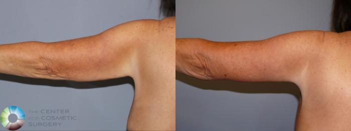 Before & After Arm Lift Case 11940 Left Side View in Golden, CO