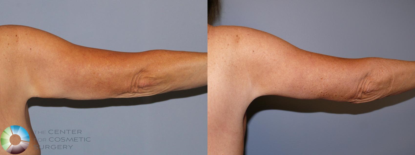Before & After Arm Lift Case 11940 Right Side in Denver and Colorado Springs, CO