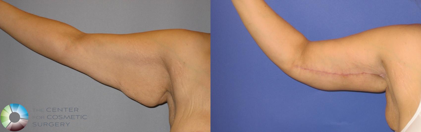 Before & After Arm Lift Case 126 View #1 in Denver and Colorado Springs, CO