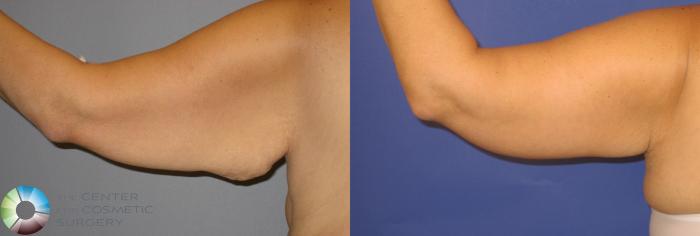 Before & After Arm Lift Case 126 View #2 View in Golden, CO
