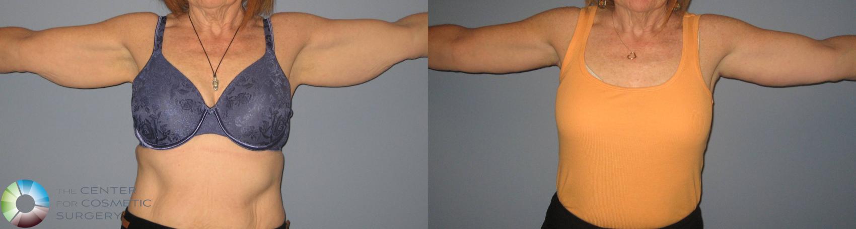 What Options Are There To Remove Arm Flab in Denver?