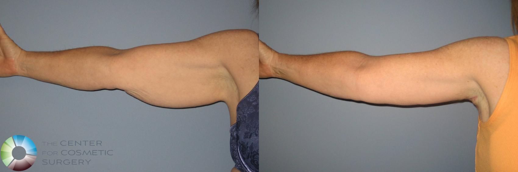 Before & After Arm Lift Case 441 View #2 View in Denver & Golden, CO