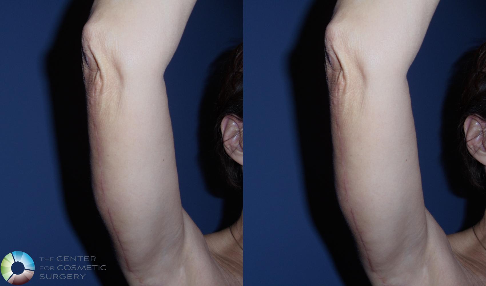 Before & After Arm Lift Case 442 View #2 View in Denver & Golden, CO