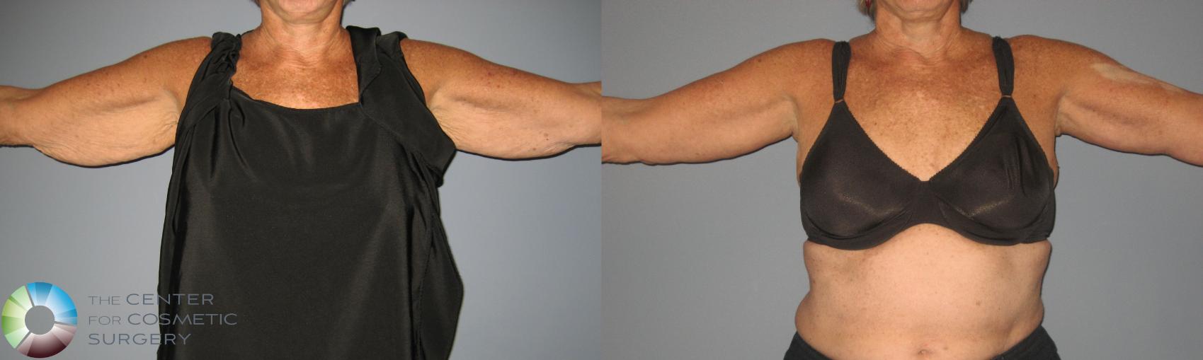 What Options Are There To Remove Arm Flab in Denver?