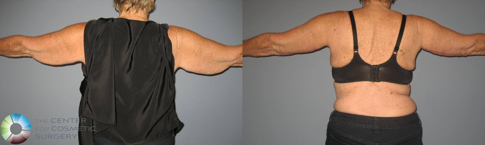 Before & After Arm Lift Case 450 View #2 View in Denver & Golden, CO