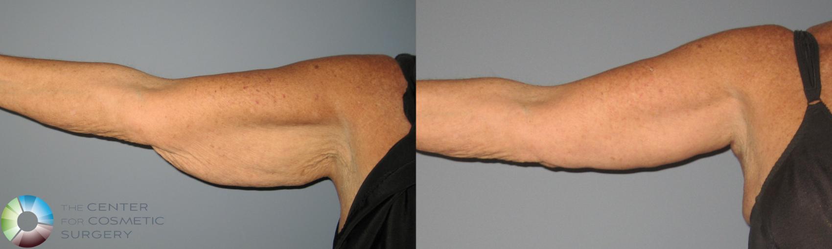 Before & After Arm Lift Case 450 View #3 View in Denver & Golden, CO