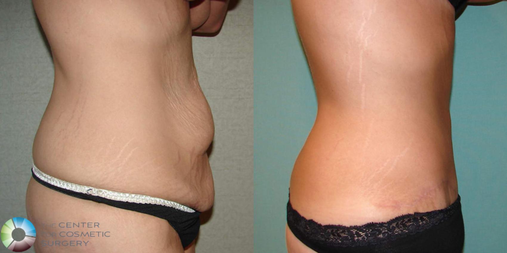 Before & After Arm Lift Case 508 View #2 View in Golden, CO