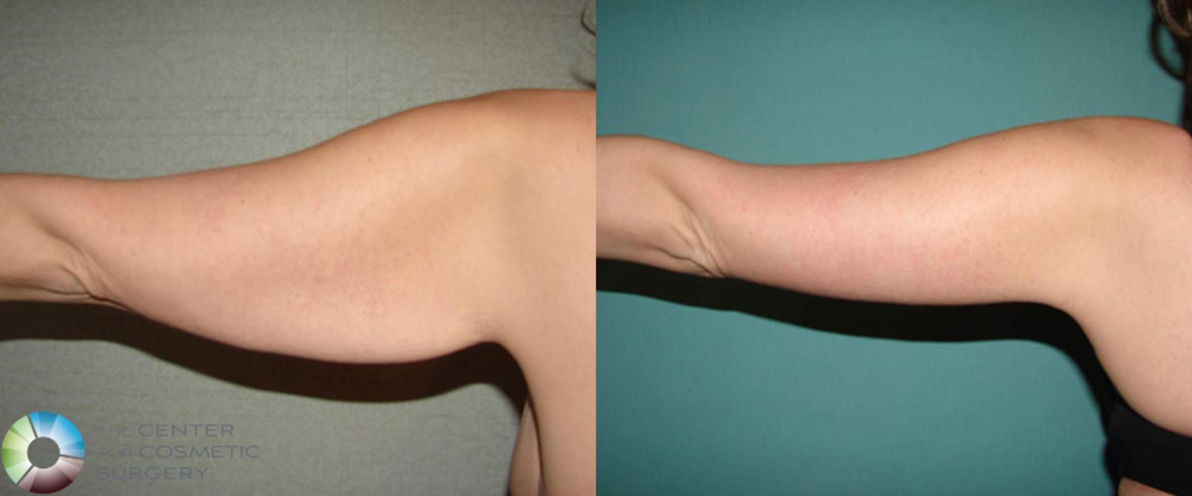 Before & After Arm Lift Case 508 View #7 View in Denver & Golden, CO