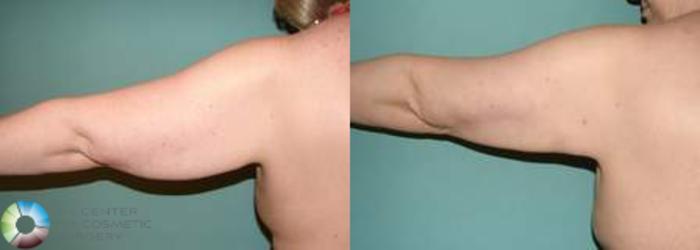 Before & After Arm Lift Case 539 View #1 View in Golden, CO