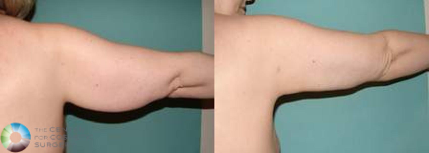 Before & After Arm Lift Case 539 View #2 in Denver and Colorado Springs, CO