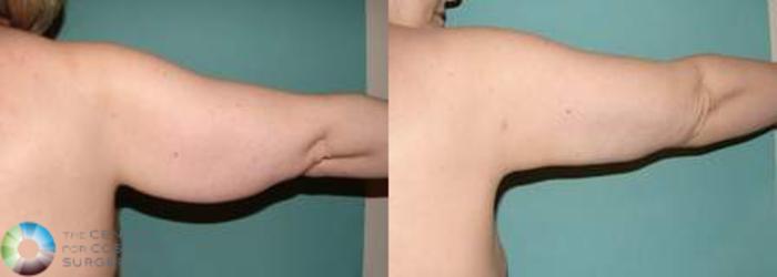 Before & After Arm Lift Case 539 View #2 View in Golden, CO