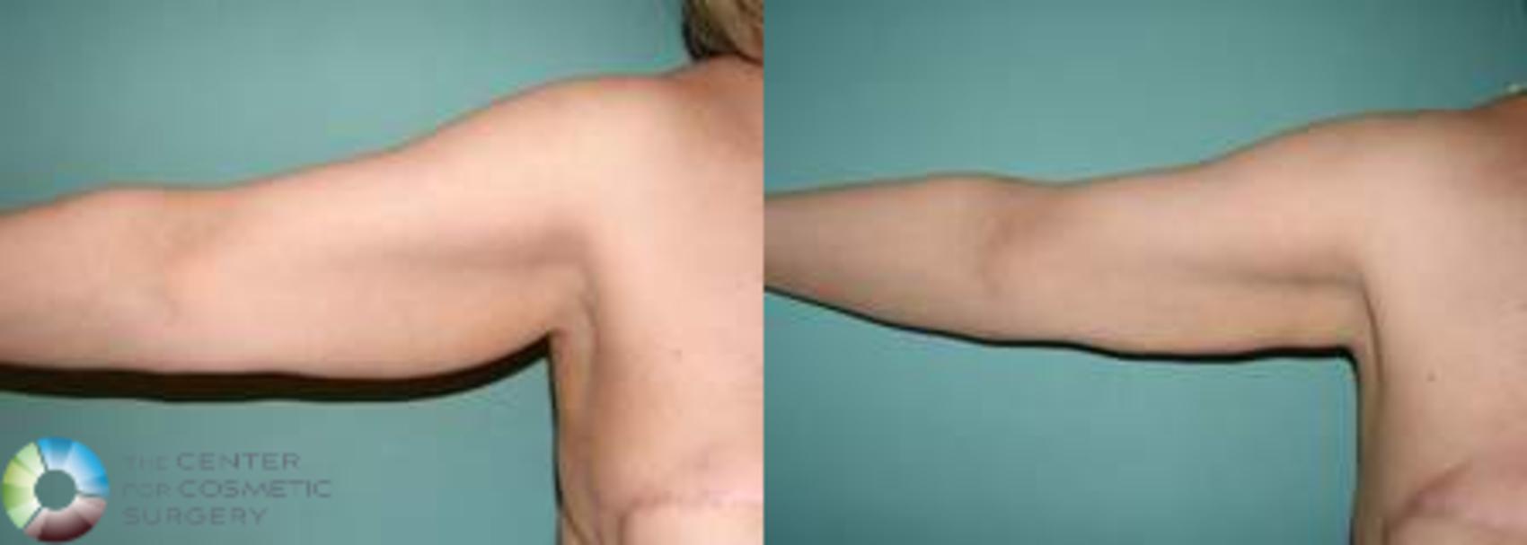 Before & After Arm Lift Case 539 View #3 in Denver and Colorado Springs, CO