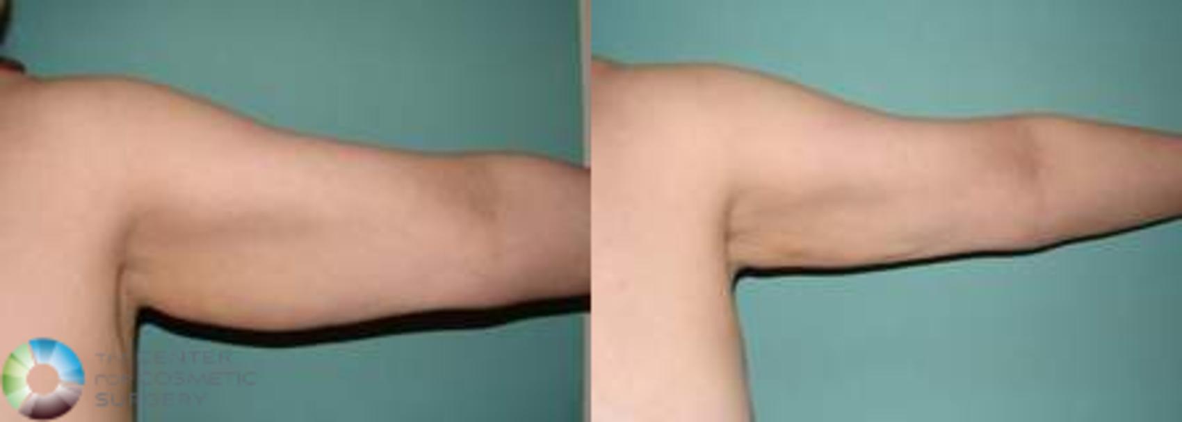Before & After Arm Lift Case 539 View #4 in Denver and Colorado Springs, CO