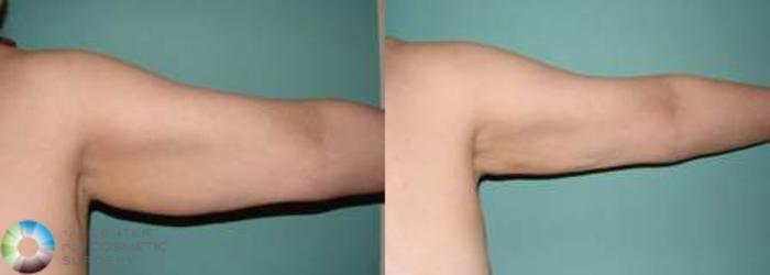 Before & After Arm Lift Case 539 View #4 View in Golden, CO