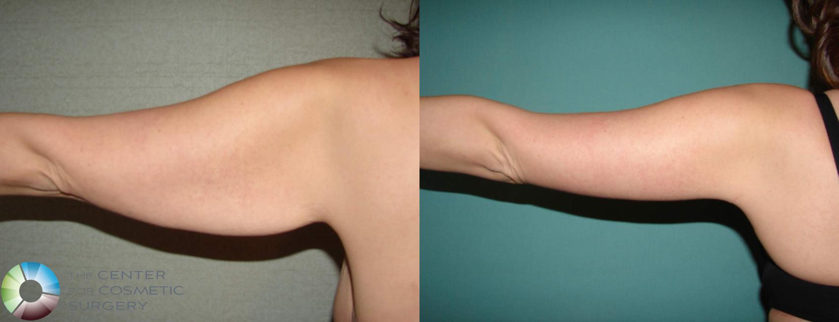 Before & After Arm Lift Case 624 View #1 in Denver and Colorado Springs, CO