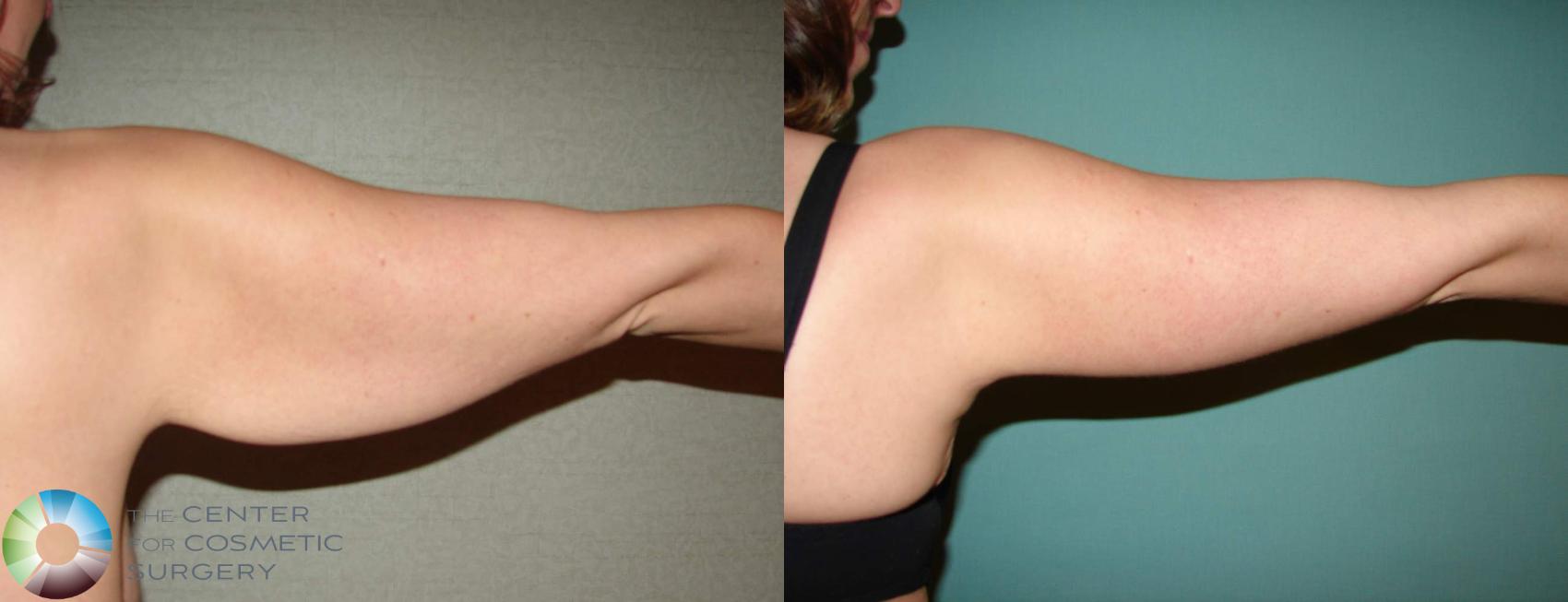 Before & After Arm Lift Case 624 View #2 View in Denver & Golden, CO