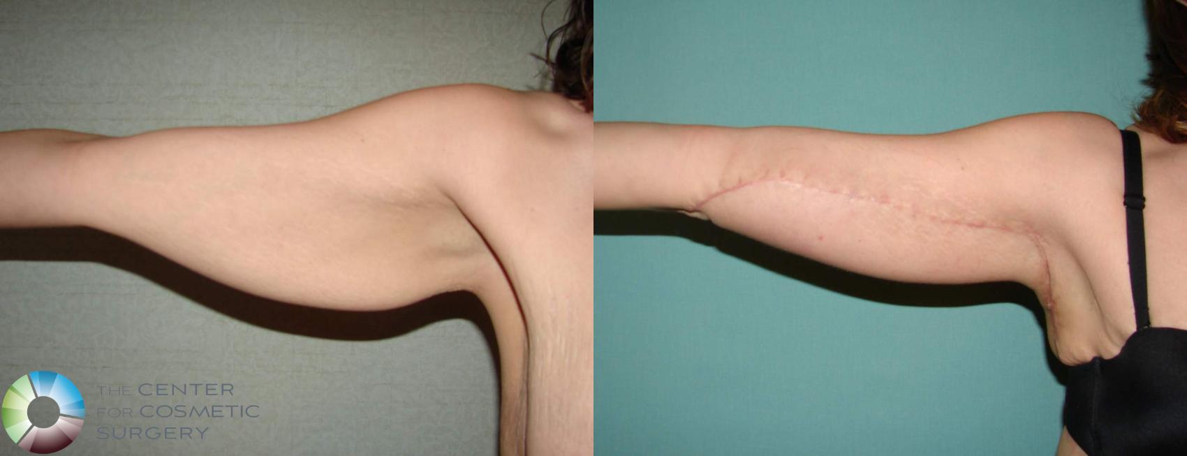 Before & After Arm Lift Case 624 View #3 View in Golden, CO