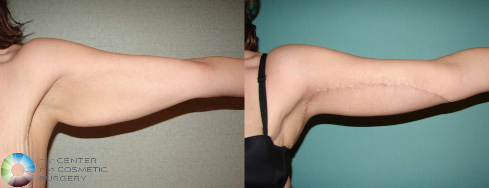 Before & After Arm Lift Case 624 View #4 View in Denver & Golden, CO