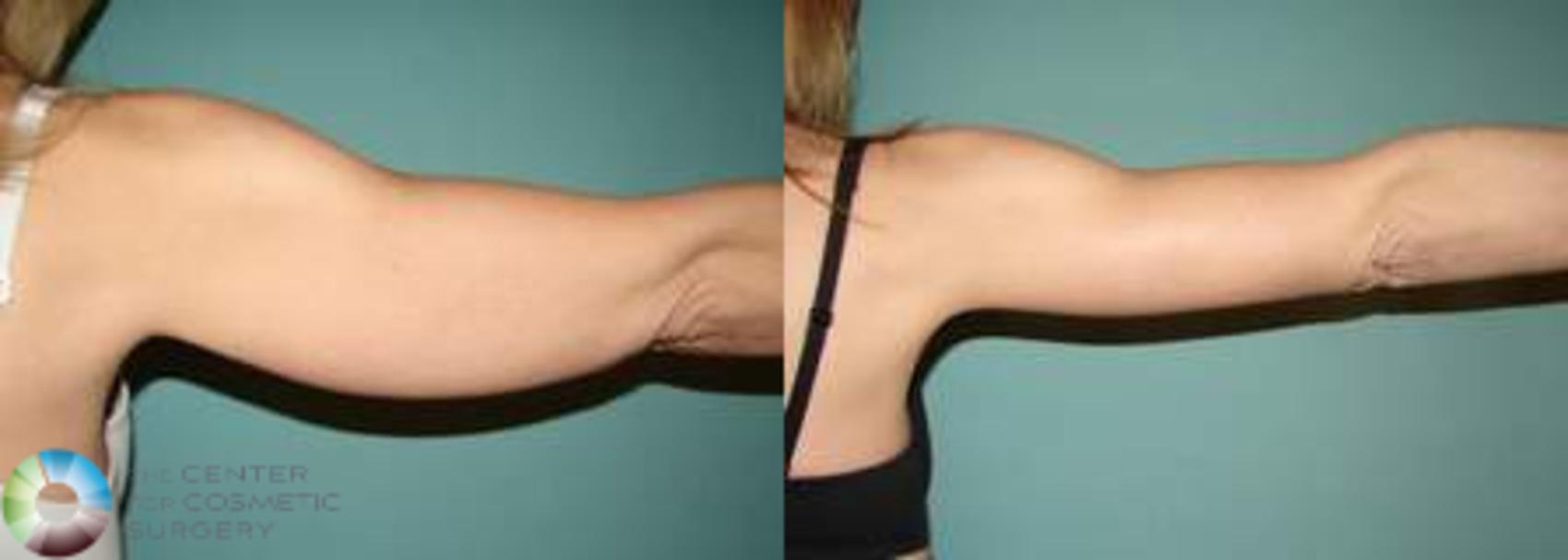 Before & After Arm Lift Case 628 View #2 View in Denver & Golden, CO