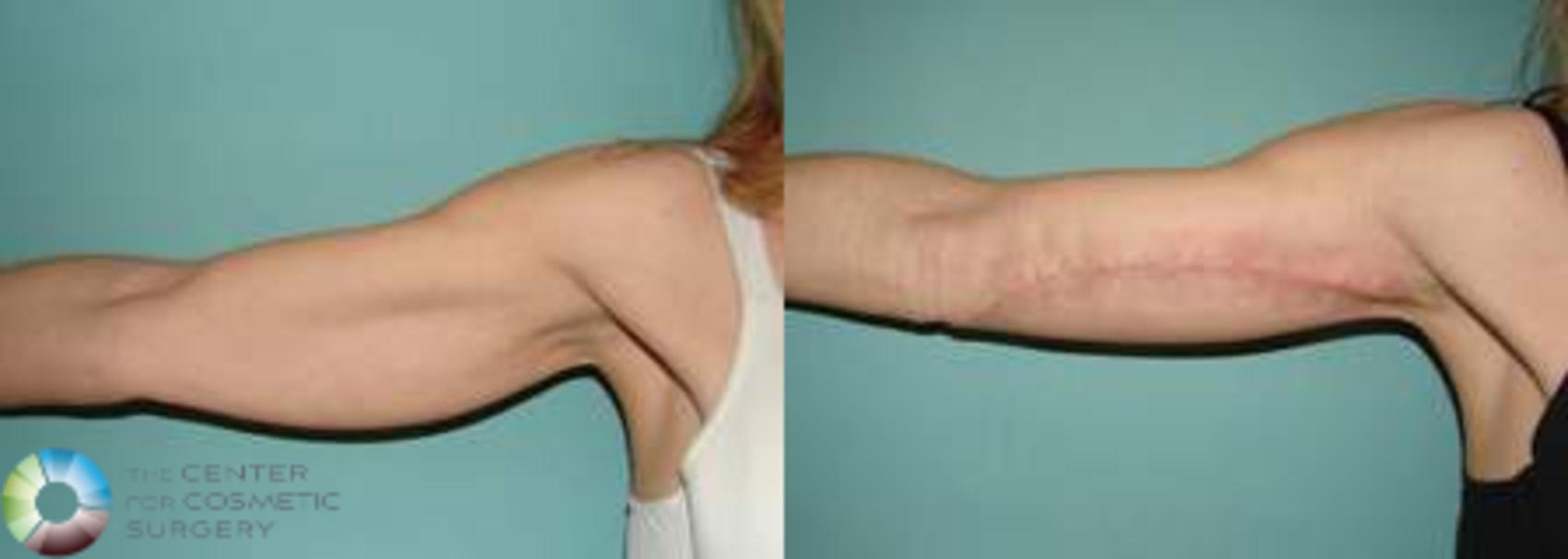 Before & After Arm Lift Case 628 View #3 View in Denver & Golden, CO