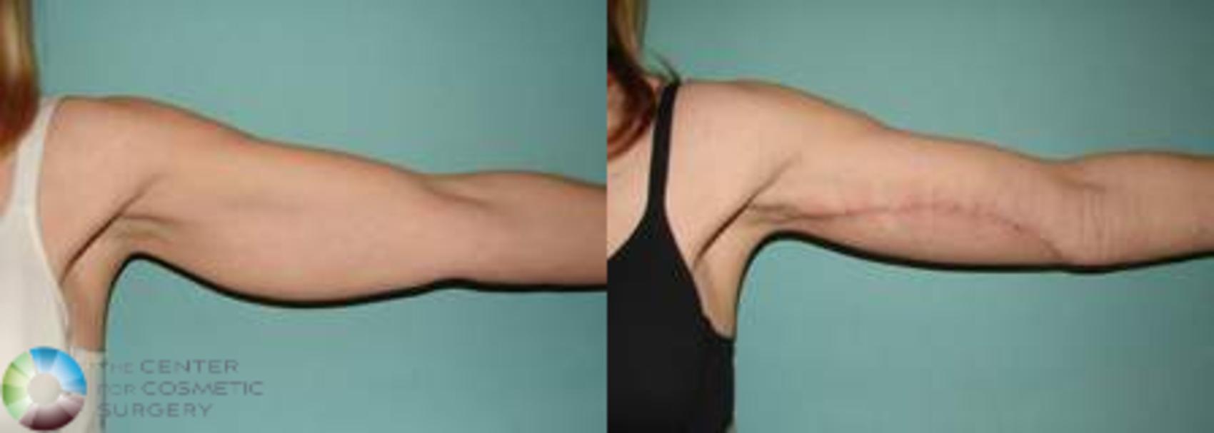 Before & After Arm Lift Case 628 View #4 View in Golden, CO