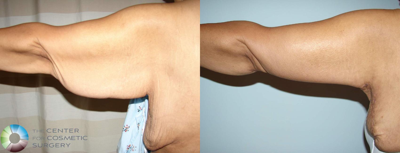 Before & After Arm Lift Case 630 View #1 in Denver and Colorado Springs, CO