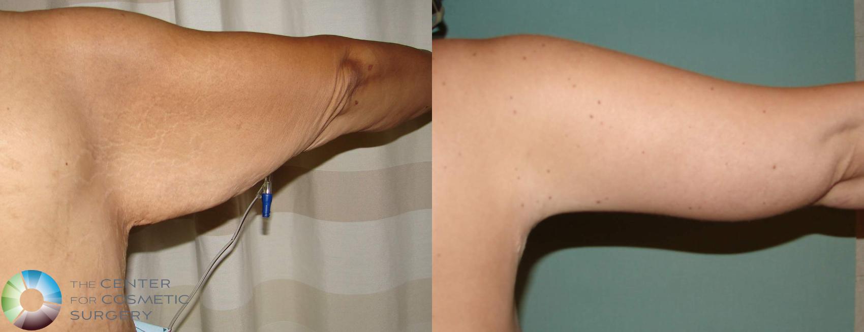 Before & After Arm Lift Case 630 View #2 View in Denver & Golden, CO