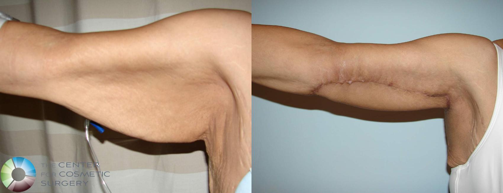 Before & After Arm Lift Case 630 View #3 View in Denver & Golden, CO