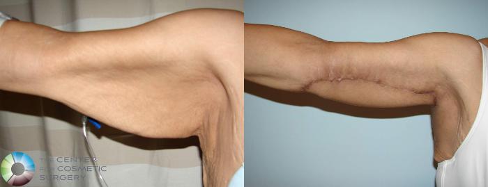 Before & After Arm Lift Case 630 View #3 View in Golden, CO