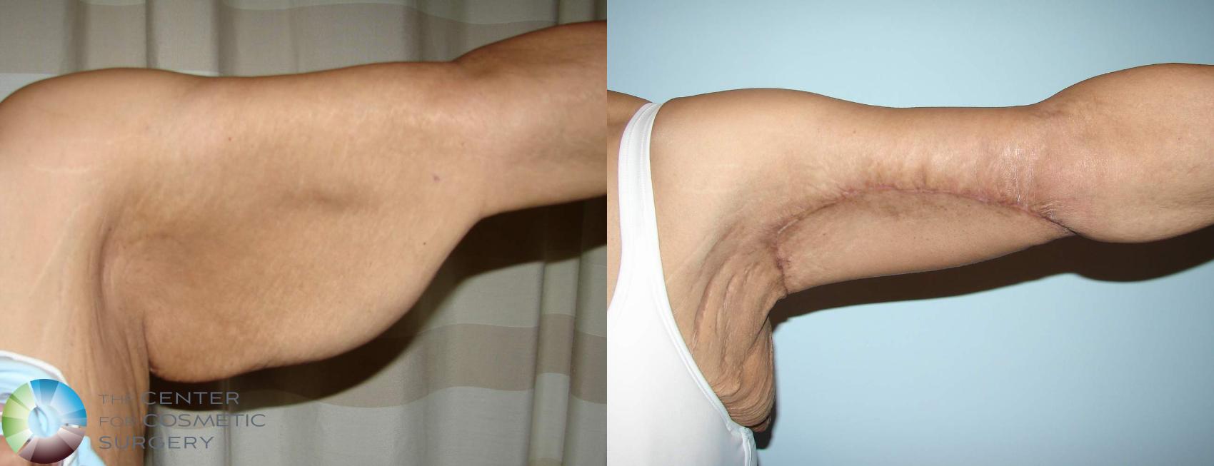 Before & After Arm Lift Case 630 View #4 View in Denver & Golden, CO