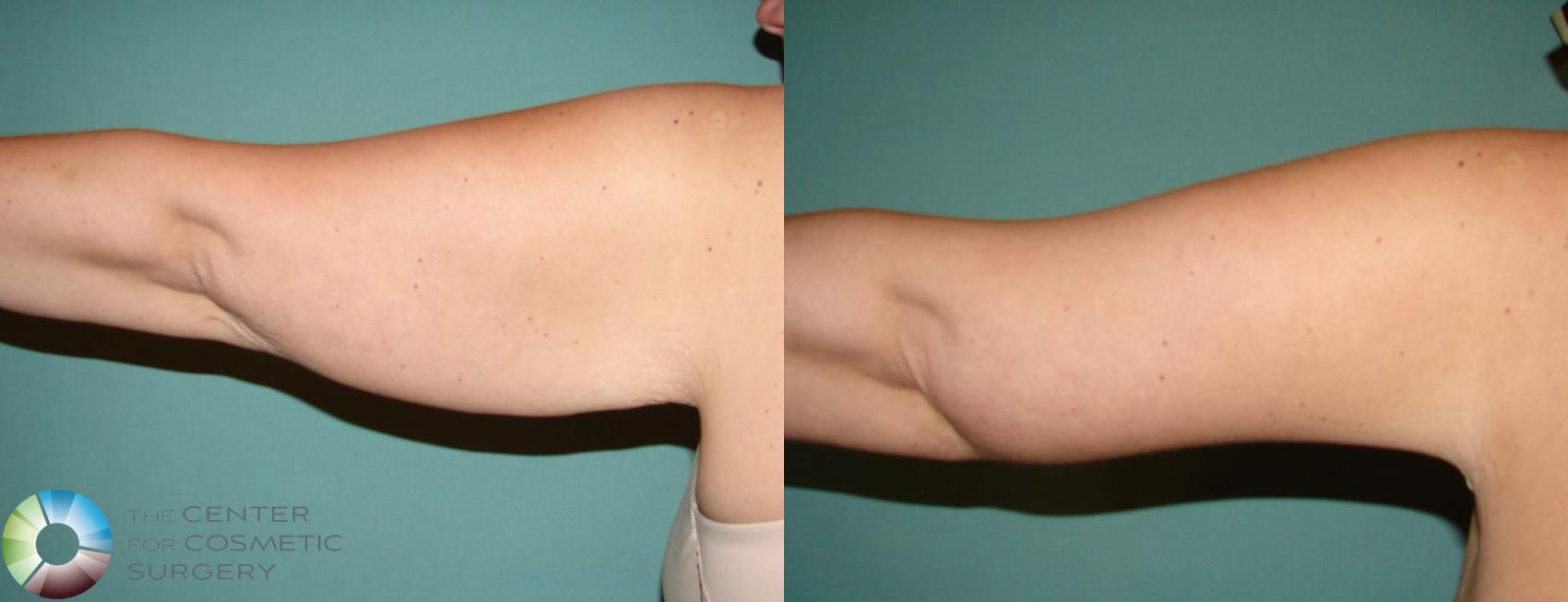 Before & After Arm Lift Case 631 View #1 in Denver, CO