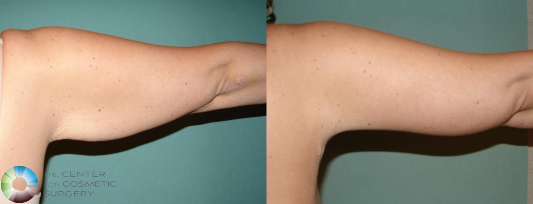 Before & After Arm Lift Case 631 View #2 View in Denver & Golden, CO