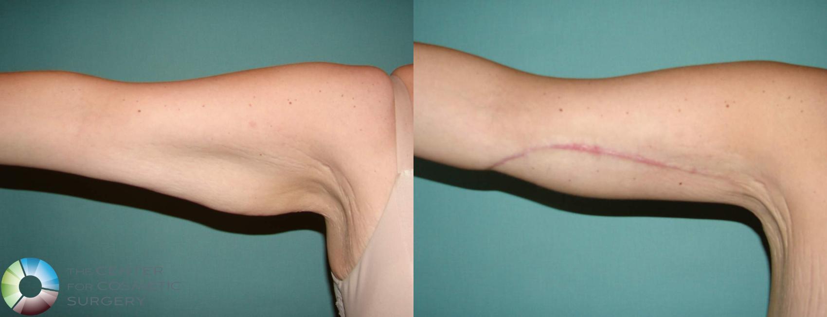 Before & After Arm Lift Case 631 View #3 View in Denver & Golden, CO