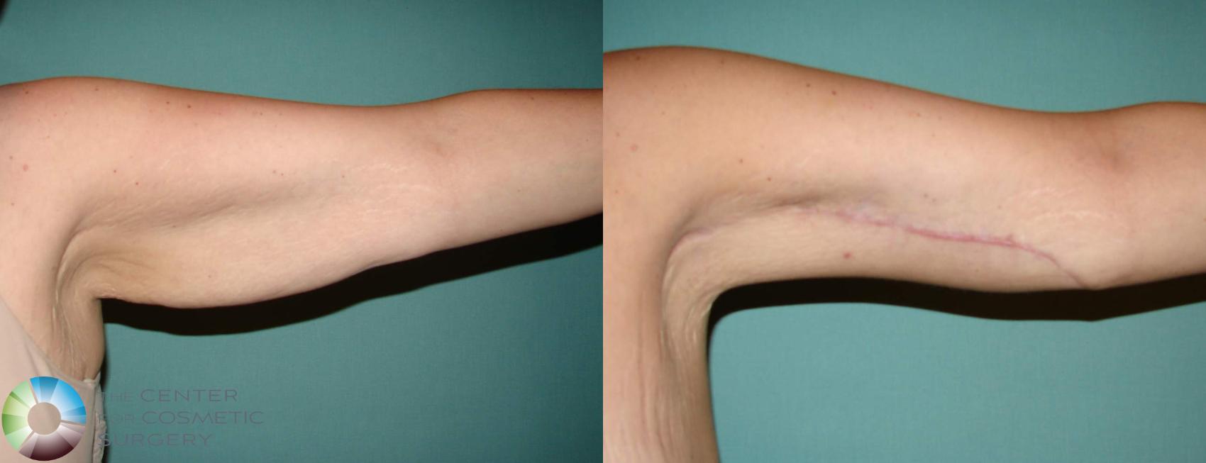 Before & After Arm Lift Case 631 View #4 View in Denver & Golden, CO