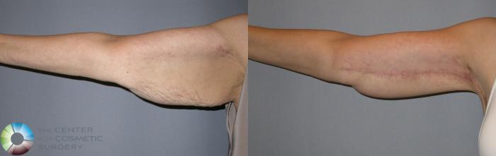 Before & After Arm Lift Case 77 View #1 in Denver and Colorado Springs, CO