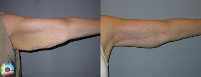 Before & After Arm Lift Case 77 View #2 in Denver and Colorado Springs, CO