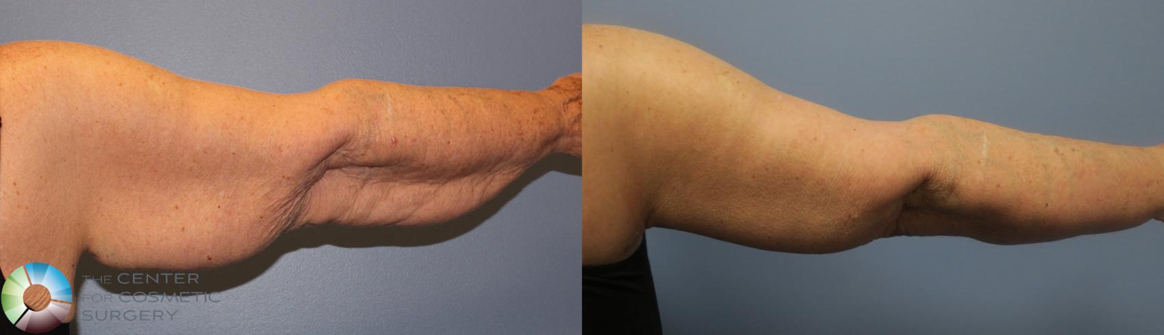 Before & After Arm Lift Case 839 View #2 in Denver and Colorado Springs, CO