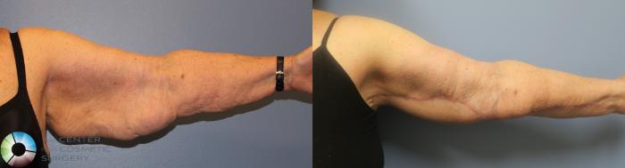 Before & After Arm Lift Case 839 View #3 View in Golden, CO