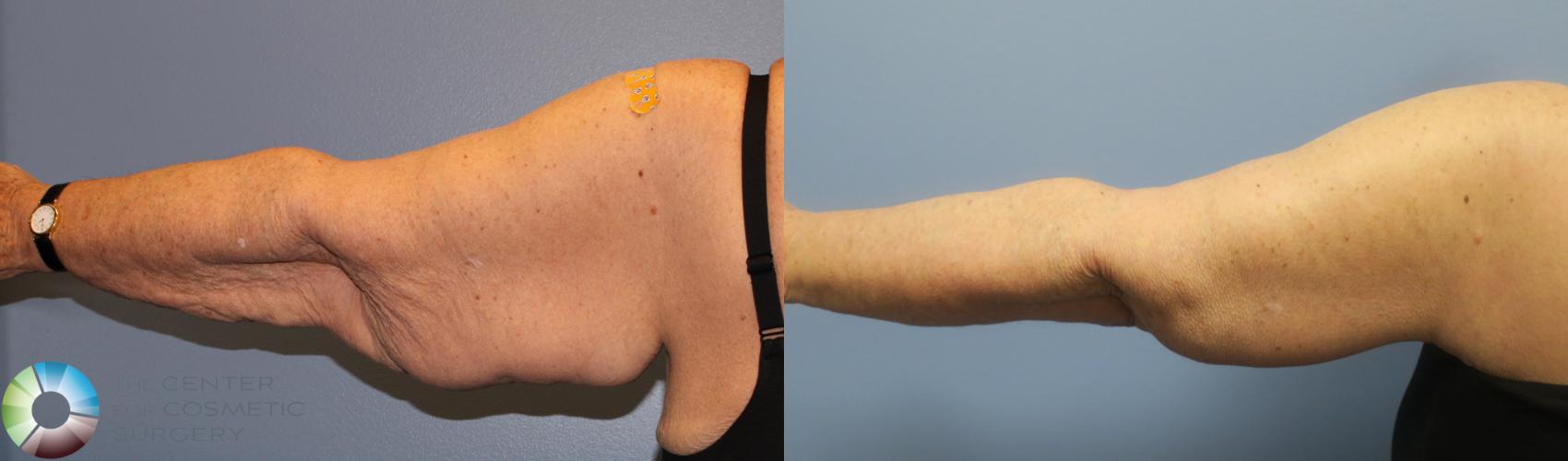 Before & After Arm Lift Case 839 View #4 in Denver and Colorado Springs, CO