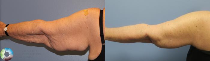 Before & After Arm Lift Case 839 View #4 View in Golden, CO