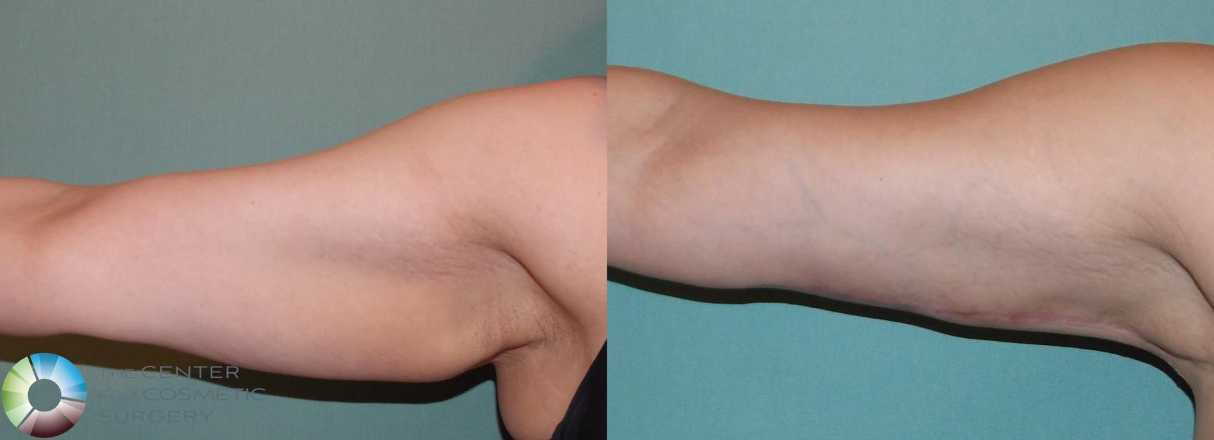 Before & After Arm Lift Case 865 View #1 in Denver and Colorado Springs, CO