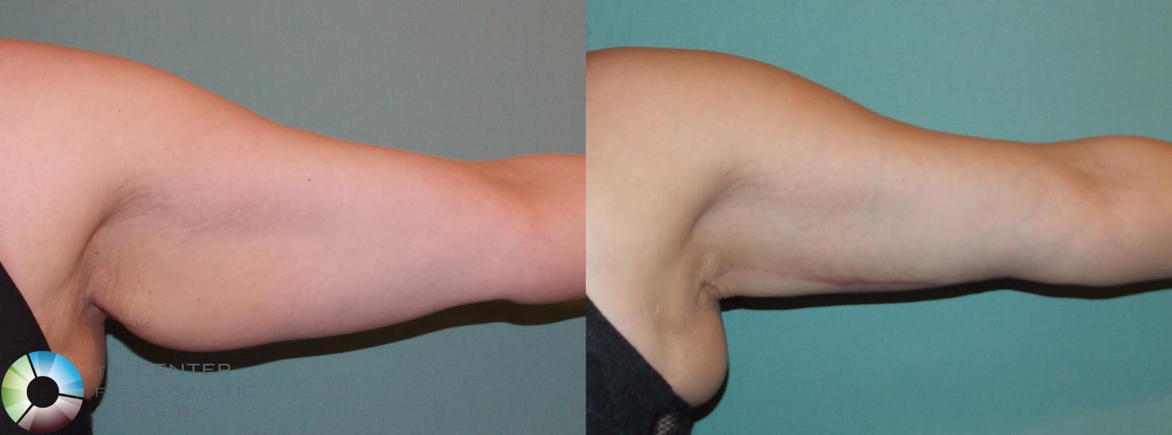 Before & After Arm Lift Case 865 View #2 View in Golden, CO