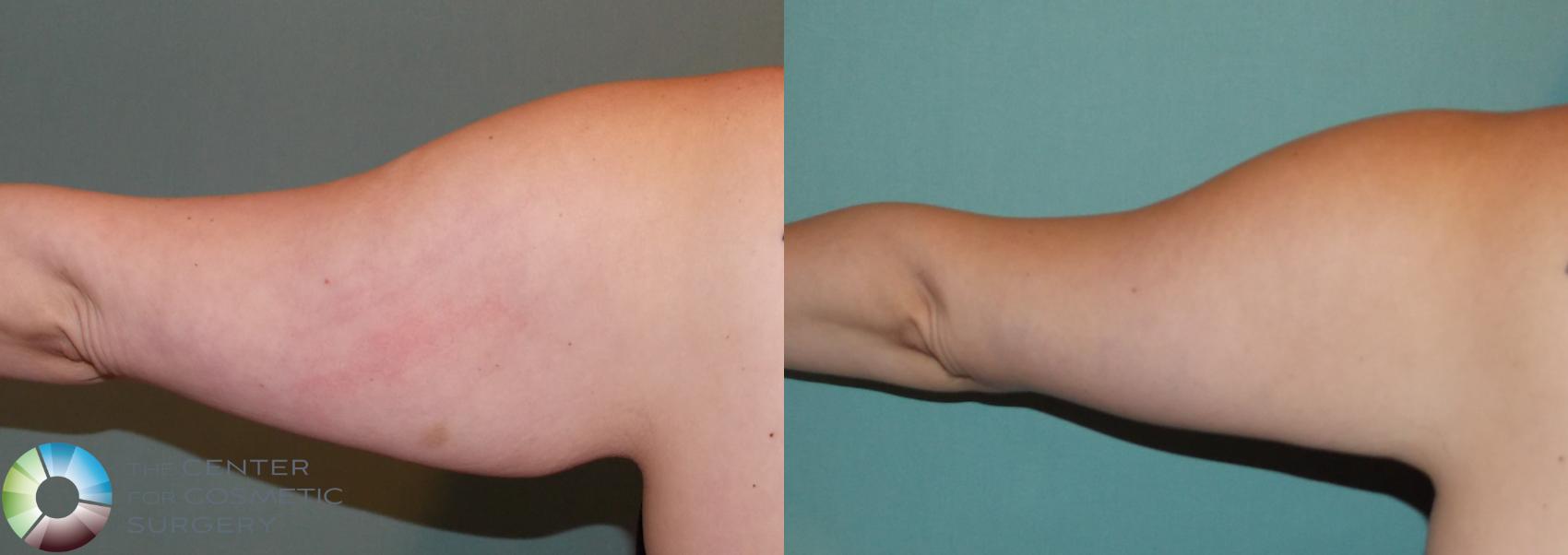Before & After Arm Lift Case 865 View #3 View in Denver & Golden, CO