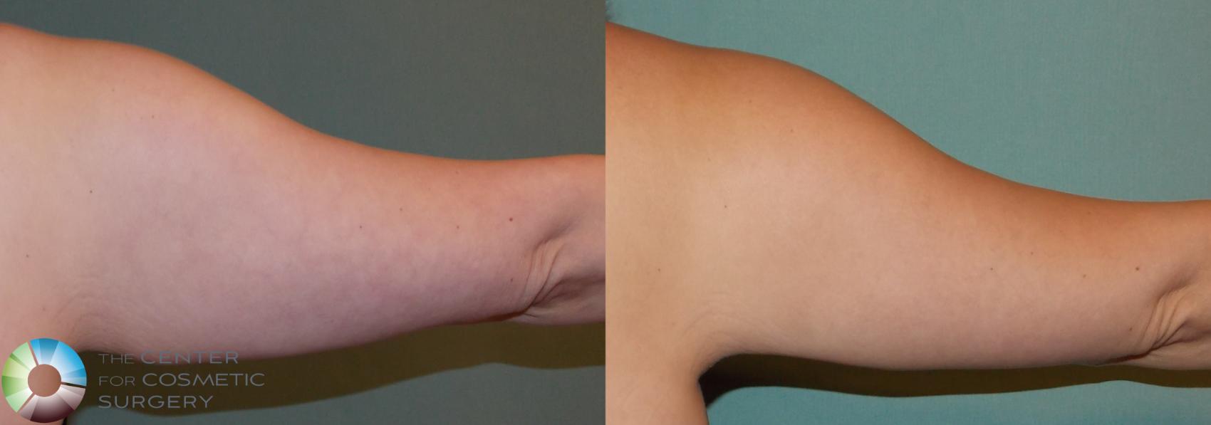 Before & After Arm Lift Case 865 View #4 View in Denver & Golden, CO