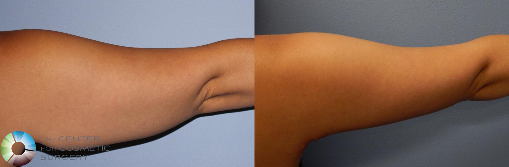 Before & After Arm Lift Case 886 View #2 View in Denver & Golden, CO