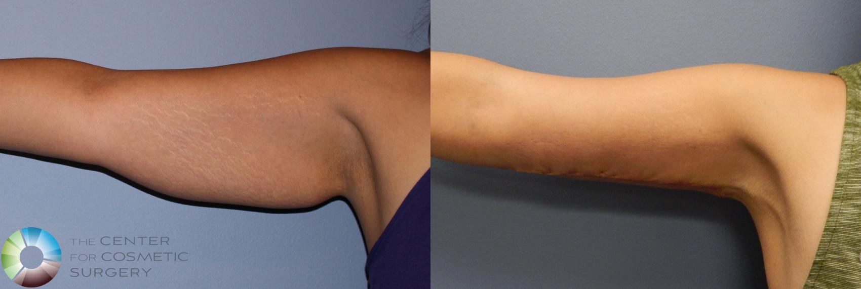 Before & After Arm Lift Case 886 View #3 View in Denver & Golden, CO