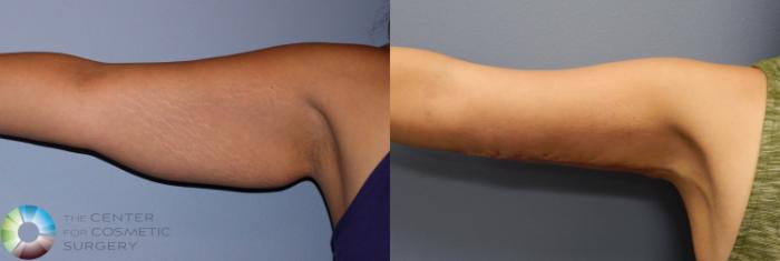 Before & After Arm Lift Case 886 View #3 View in Golden, CO
